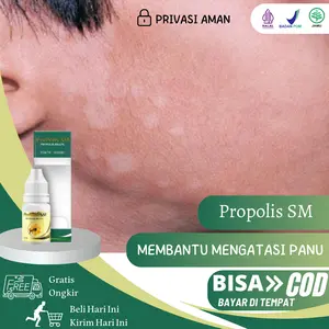 Propolis SM - Salep Panu Di Wajah, Panu di badan, panu di tangan, hapuran, balas bogo, bercak putih, jamur putih, Malassezia furfur, tinea versicolor, pityriasis versicolor