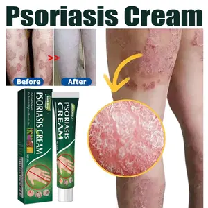 [Penjualan Panas] Raja Anti-Gatal!Krim Herbal Asli, Spesialisasi Eksim dan Dermatitis Jamur, Efek Terlihat Salep Gatal Salep Psoriasis Obat Cepat dan Efektif untuk Gatal di Bokong dan Selangkangan Obat 30g Psoriasis / Kulit Gatal / Gatal Paha Dalam Alergi