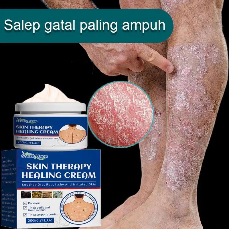 Salep gatal Salep Eksim Salep kulit Krim psoriasis paling ampuh Kulit Kepala Psoriasis Tangan Tinea Kaki Bau Versicolor Menghambat Dermatitis Jamur Anti Gatal Cream 20G
