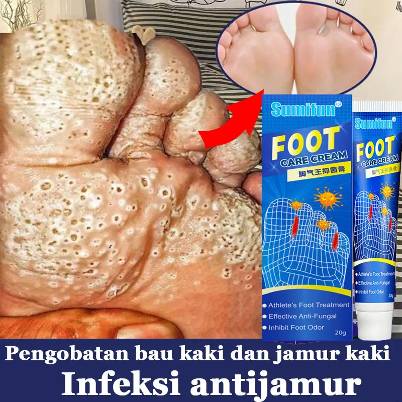 obat kaki Rayapan Dan Bau penghilang bau kaki obat jamur kaki pembersih kulit mati kaki tinea kaki anti bakteri salep Obat Kapalan kaki salep buat kaki pecah pecah obat gatal ampuh