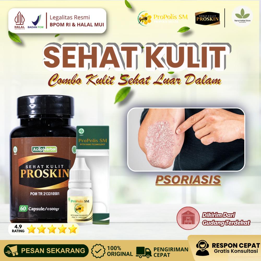 Solusi Atasi Psoriasis Vulgaris Penghilang Kulit Bersisik Dan Kulit Kering Gatal Pada Kulit Mengelupas - Propolis SM & Proskin Sehat Kulit BPOM HALAL MUI - Propolis SM