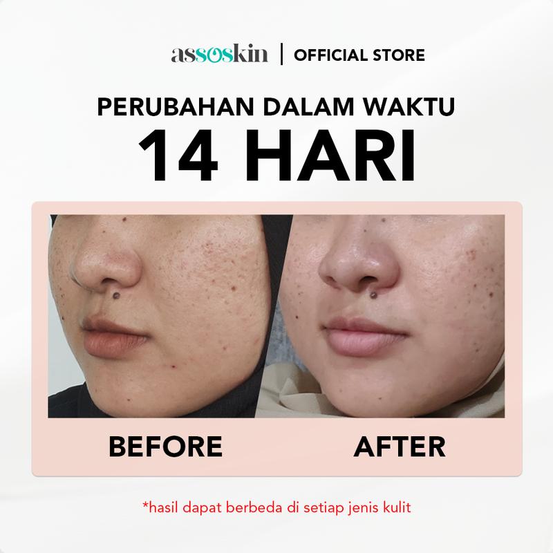 ASSOSKIN - [Bundling] Toner 100ml & Moisturizer 30ml | Pelembap dan Pembersih Pori - Pori 5