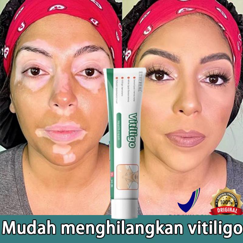 salep khusus bercak putih vitiligo salep vitiligo, bercak-bercak putih vitiligo cream bercakputih penyakit kulit putih/panu putih/kudis putih/lepra putih salep khusus bercak putih vitiligo salep vitiligo, bercak-bercak putih vitiligo cream bercakputih penyakit kulit putih/panu putih/kudis putih/lepra putih