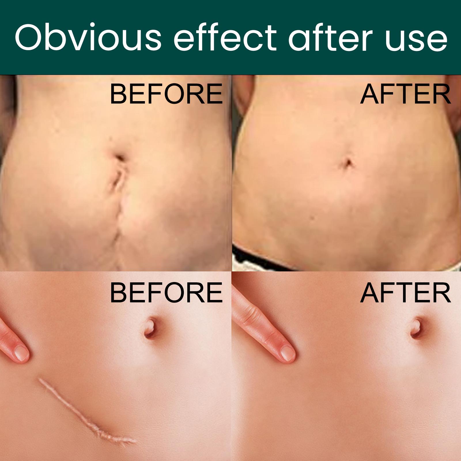 EELHOE Silicone Scar Sheets 1Roll Plester Silikon Penghilang Keloid Bekas Luka Silicon Keloid Plester Bekas Luka