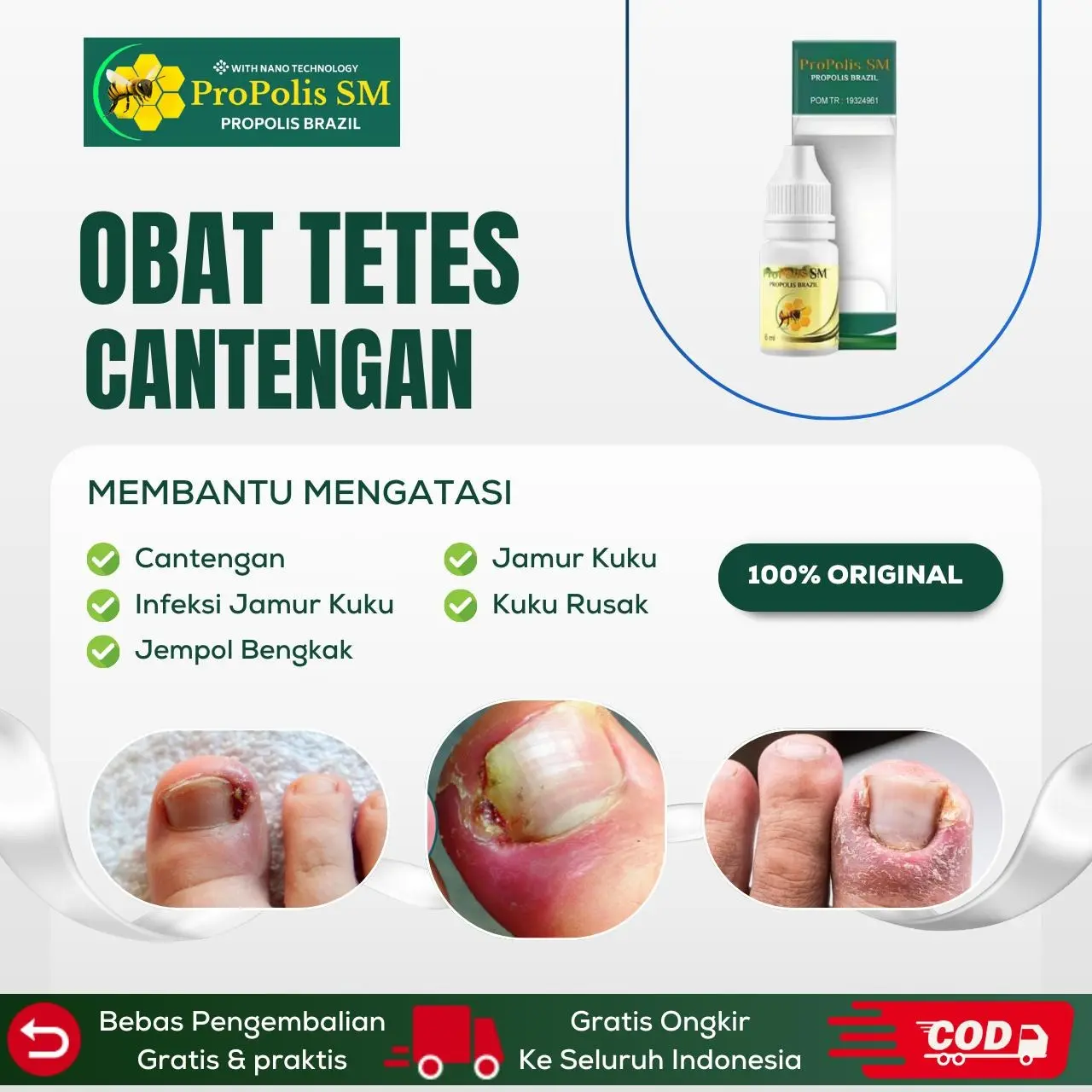 Perawatan Cantengan Jempol Kaki, Jamur Kuku Rusak, Psoriasis Kuku Jempol Bengkak, Kuku Cantengan - Propolis SM