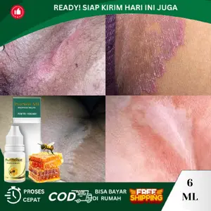 Gatal Selangkangan, Selangkangan Hitam Dan Gatal, Pemutih Selangkangan Hitam, Herbal Tetes Selangkangan, Kurap Di Selangkangan, Penghilang Hitam Diselangkangan, Selangakangan Lecet Berjamur Hidrasi