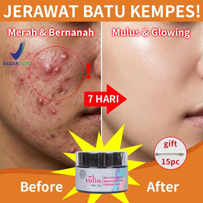 Yulin Obat Totol Jerawat Ampuh & Bekas Jerawat BPOM - Salep Acne Cream Herbal Pionin + Salicylic Acid untuk Bruntusan & Kulit Berminyak - 3PCS