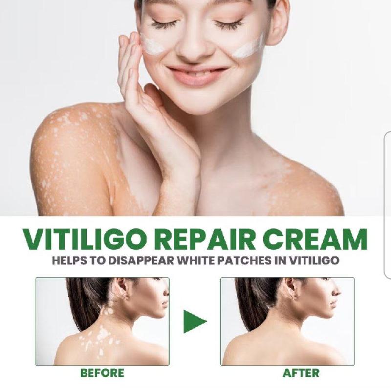 Product Introduction of krim penghilang vitiligo menghilanglan jamur panu dan mengatur pigmentasi kulit / vitiligo repair cream 19