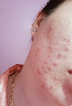 Product Review of [Mã 3] Mua 1 Tặng 1, ACNE SERUM - Serum Diếp Cá 5ml Hỗ Trợ Cải Thiện Mụn - Thương Hiệu: LE'PEAU from ** N**c Y** ** 0