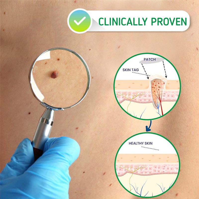 Product Introduction of Jemeesen Natural Herbal Skincare Wart Acne Remover Remove Warts Heal Skin Gentle & Effective Solution Plant Based Relief Skin Repair Skincare Acne 1
