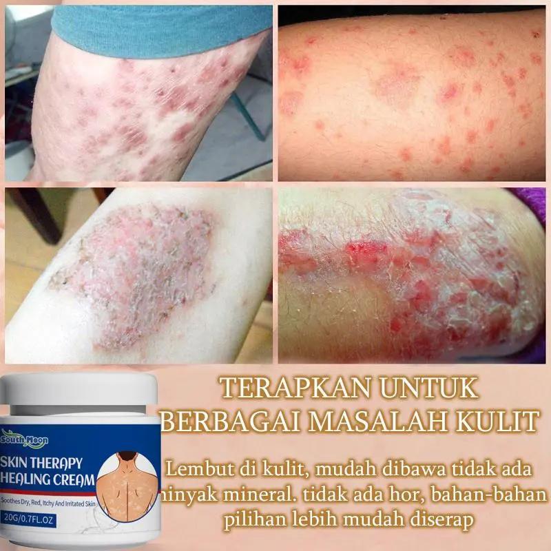 Salep gatal Salep Eksim Salep kulit Krim psoriasis paling ampuh Kulit Kepala Psoriasis Tangan Tinea Kaki Bau Versicolor Menghambat Dermatitis Jamur Anti Gatal Cream 20G