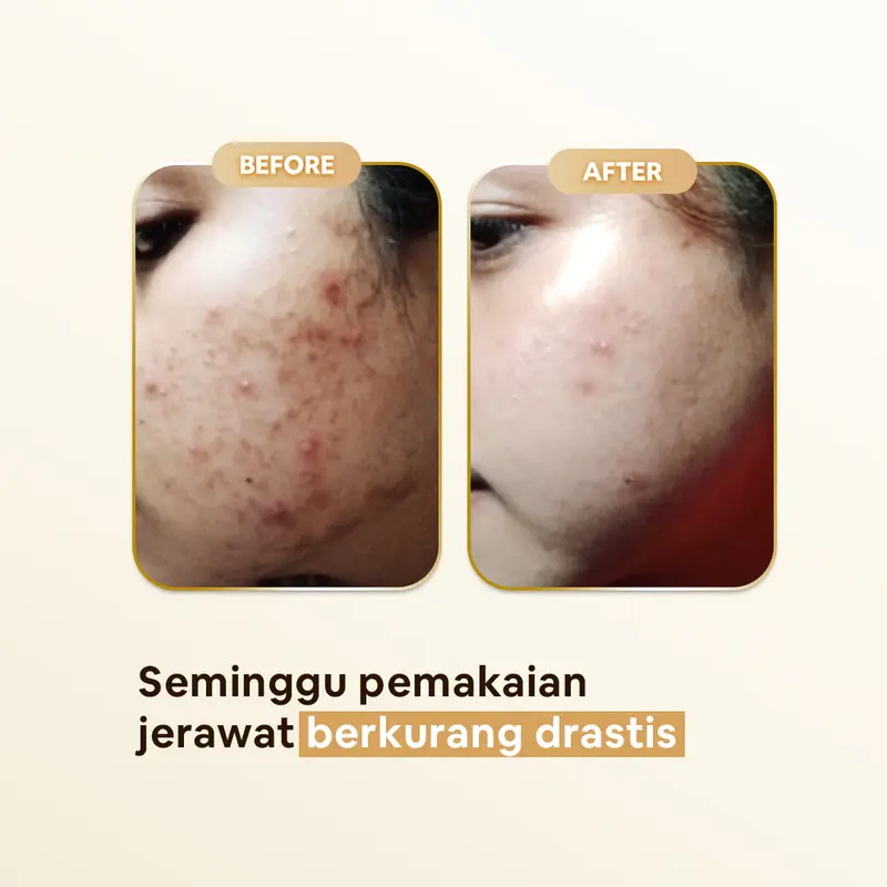 Ella Skincare Serum Matcha Sebo Control with Green Tea, BHA, Niacinamide - Mengeringkan Jerawat dlm 3 Hari 1