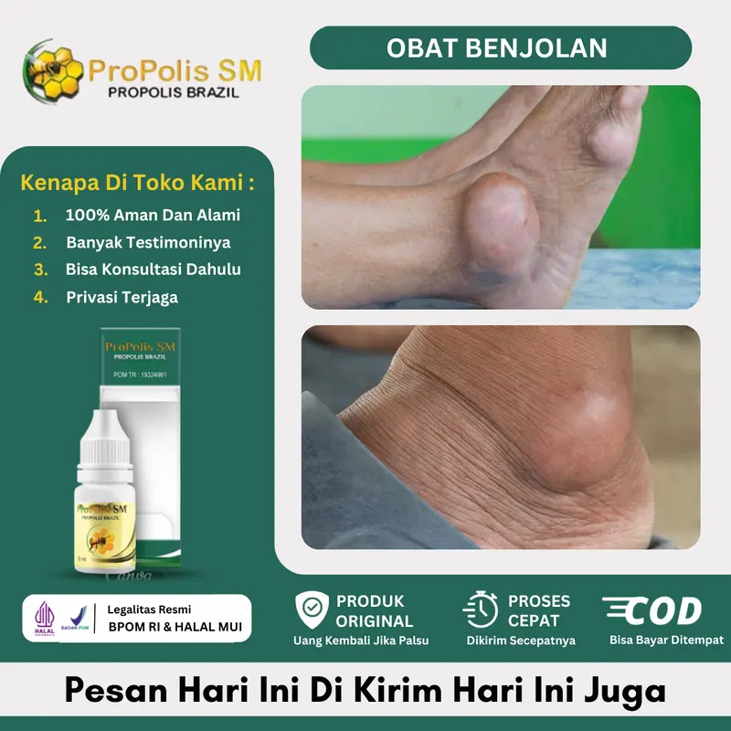 Propolis SM Benjolan pada Kaki, Penghilang Kista Ganglion  pada  Kaki,  Benjolan di Mata Kaki, Di Telapak Kaki, Benjol di tumit, Lipoma di Kaki, Penghilang Benjolan  Kaki TRADISIONAL, Benjolan Pada Sendi Kaki 0