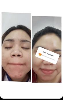 Product Review of Bogota Beauty Skincare Bogota Normal Series Bogota Acne Series by Bogota Beauty Semua Jenis Kulit from C**🍫 0