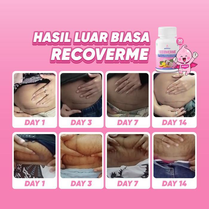 Promo Terlaris MOMSY RECOVERME Pemulih Luka Lahiran Lengkap Dengan 3 Bahan Aktif Sinergis Ikan Gabus Daun Binahong Enzim Bromelain