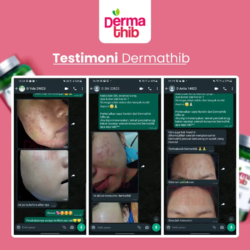 Dermathib Perawatan Jerawat dan Bekas Jerawat Wajah, Jerawat Meradang, Jerawat Punggung, Jerawat Bopeng Gatal Berjerawat BPOM Isi 60 7
