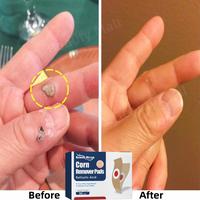 Gambar Plester mata ikan Hilangkan Mata Ikan di Telapak Kaki dan Tangan Penghilang Kutil dan Kapalan - 24 pcs/kantong dari NEXALU Kab. Bogor 4 Tokopedia