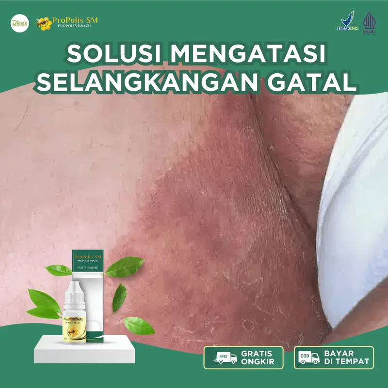Salep Cair Selangkangan Berjamur, Selangkangan Lecet, Paha Gatal Dan Hitam, Gatal Selangkangan, Infeksi Jamur Selangkangan Asli 100% Original 0