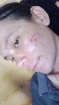 Product Review of [ORI] Serum Perawatan Muka Berjerawat Bruntusan - Acneno Isi 12 ml | Bantu Atasi Wajah Bruntusan Berminyak Kusam Mengandung Niacinamide | BPOM Original from k**a 0