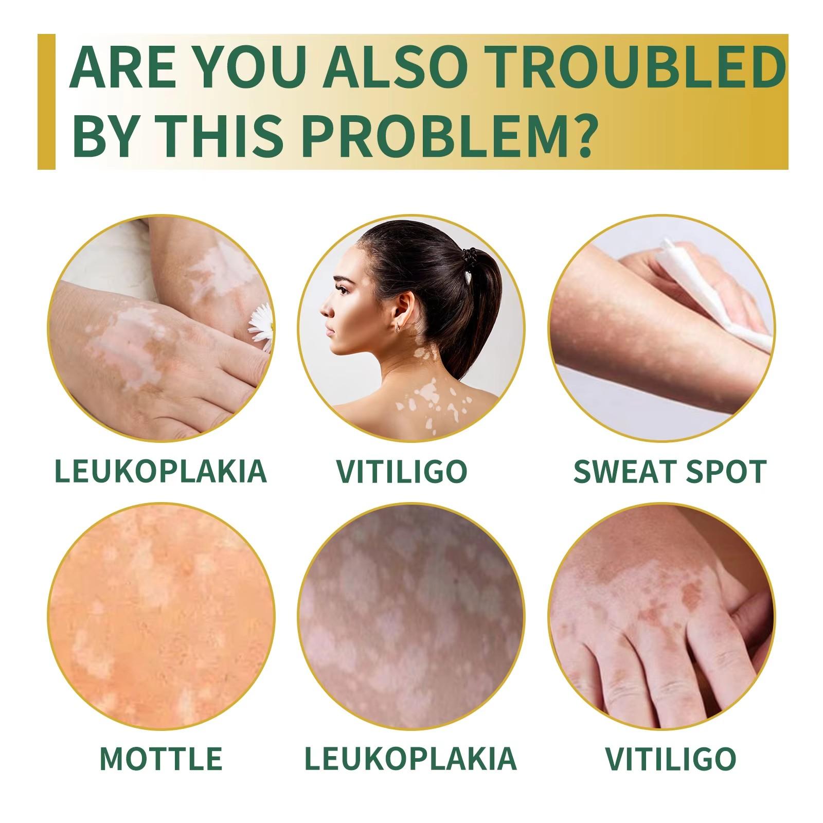 Obat Penghilang Vitiligo Salep Krim Vitiligo Bintik Putih Salep vitiligo Obat vitiligo untuk kulit bercak putih jerawat keringat  krim concealer noda melanin salep khusus vitiligo
