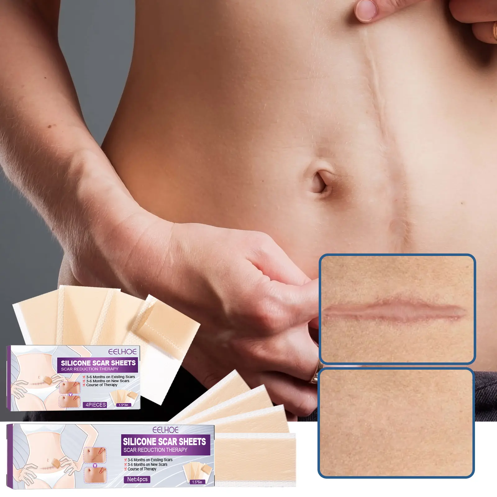 Silicone Scar Sheet Gel Silikon Penghilang Keloid Bekas Luka  Ampuh Plester Bekas Luka Menghilangkan Tambalan Bekas Luka  & Keloid Plaster Penghilang Bekas Luka Keloid Operasi Stretch Mark 4 PCS 4cm x 7.5cm