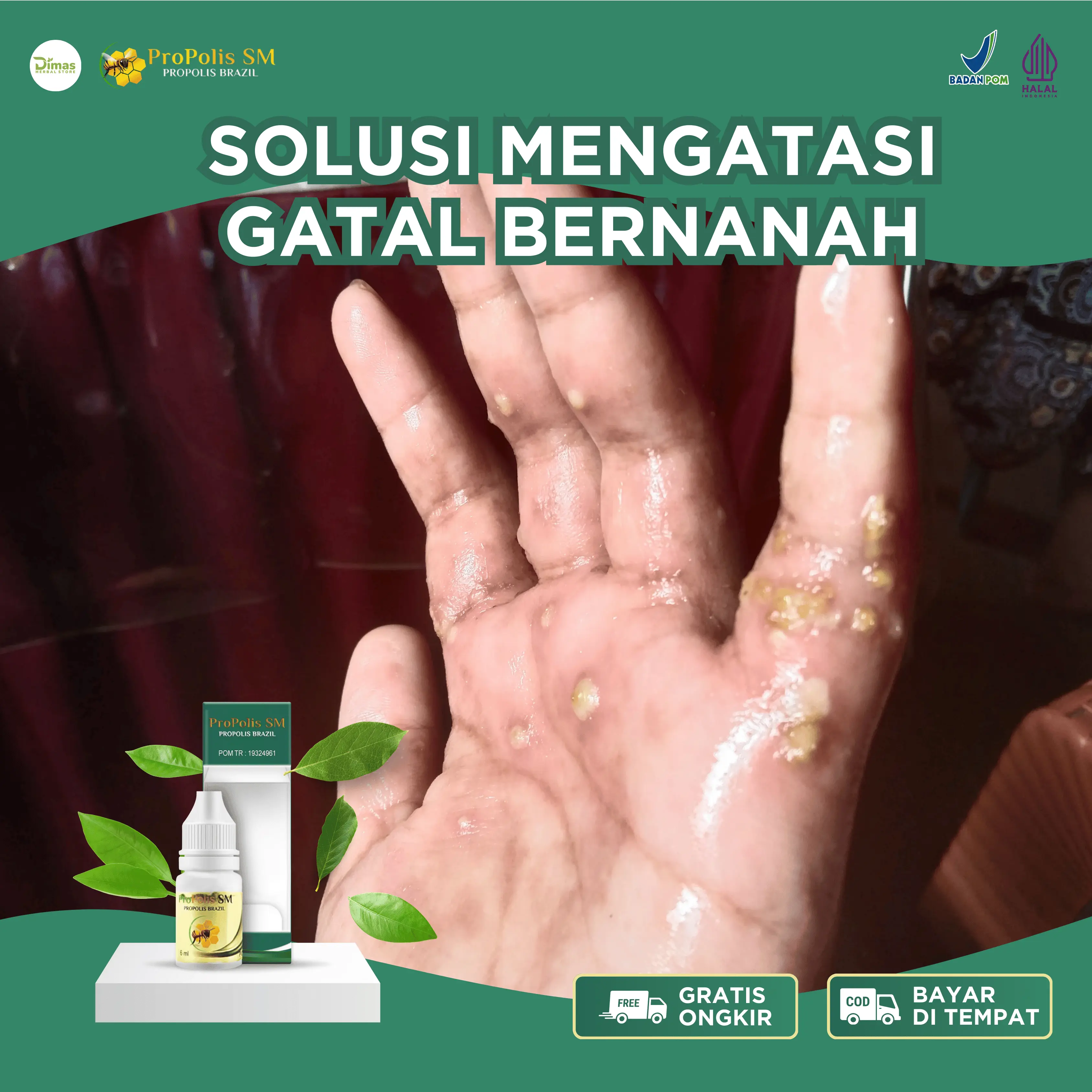 Salep Gatal Bernanah, Jamur Gatal, Cenang Bernanah Di Kulit Tangan Dan Kaki, Budug, Gatal Berair, Kudis Bernanah, Menghilangkan Gatal Kulit Dengan Propolis SM