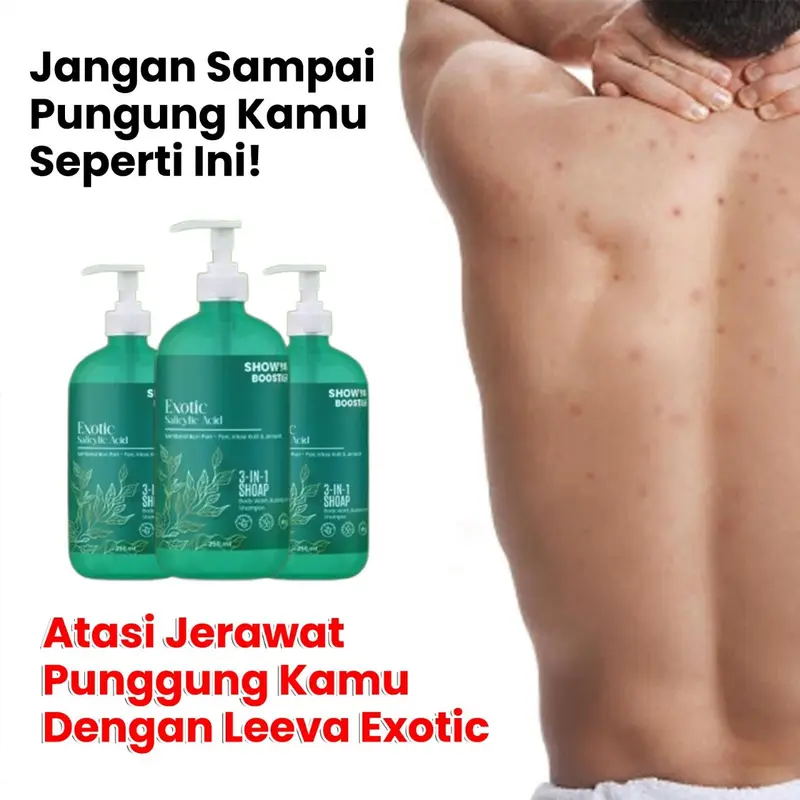 Leeva Sabun Exotic Acne 250ml - Sabun Mandi Kulit Sensitif, Mengatasi Jerawat & Panu, Melembabkan Kulit Kering, Solusi Kulit Sehat dan Bersih 1