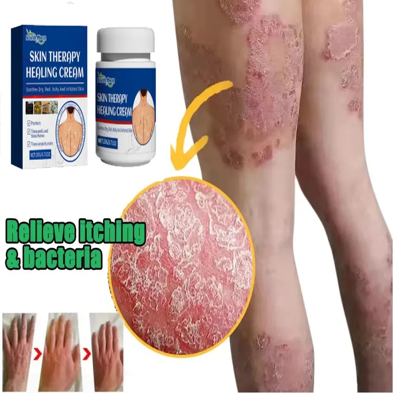 South Moon Salep Khusus Psoriasis - psoriasis ointment - Kurap Pada Kulit Kepala - Kutu Air - Kurap Pada Badan - Eksim - Infeksi Kulit - Obat Luar Mengatasi Gatal 20g Perawatan Tubuh Kering Pembersihan 0