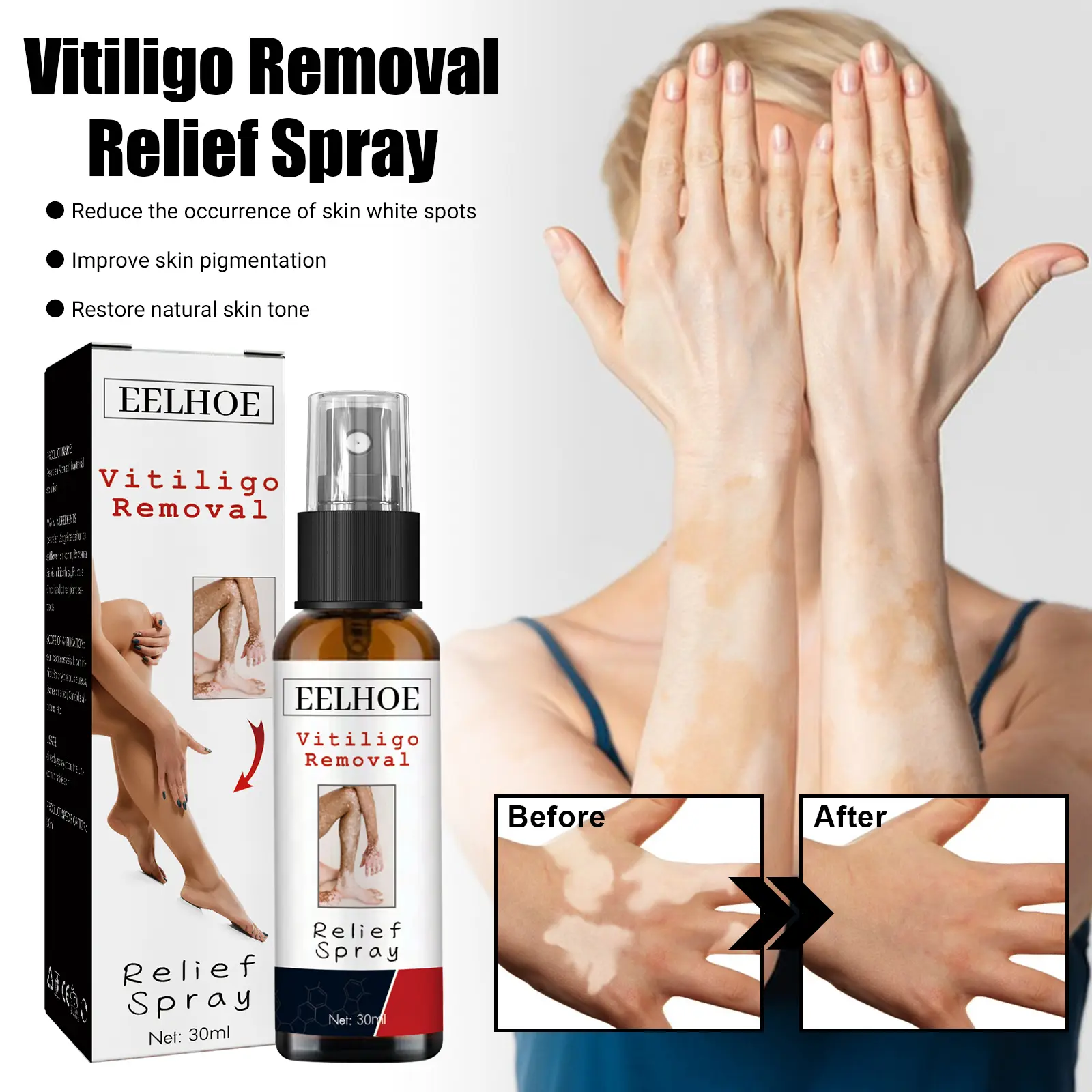 Vitiligo Removal Relief Spray White Spot Desalination Treatment Cream Repair Spray Cover Ointment 30ml Obat Penyakit Vitiligo Salep Obat Panu Obat Vitiligo Semprotan Perbaikan Bintik Putih Perawatan Kulit