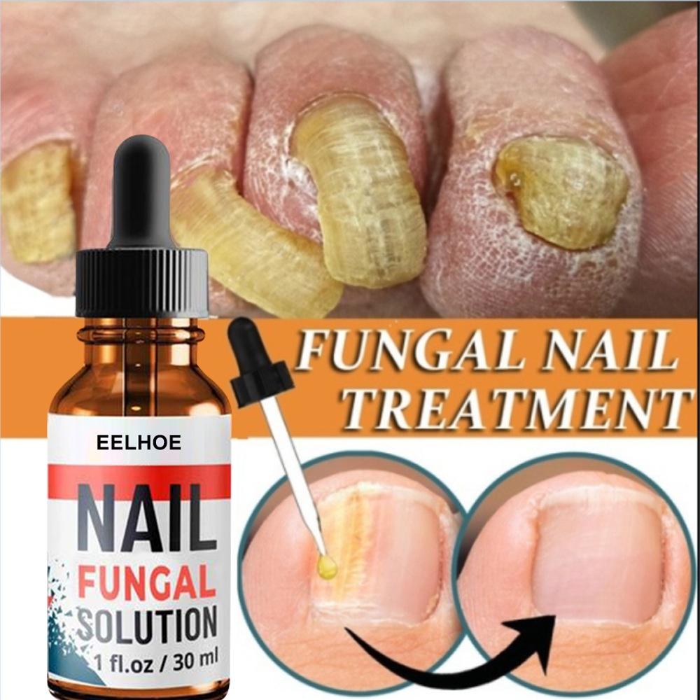 EELHOE Nail Repair Serum Fungal Nail Perawatan Esensi Serum Jamur Kuku Essence Oil Serum Nail Treatment Serum 30ml