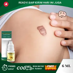 Untuk Keloid, Keloid Menonjol Tahunan, Penghilang Bekas Luka Koreng Lama Hitam, Keloid Daging Tumbuh, Keloid Menahun, Keloid di Telinga, Keloid Bekas Tindik