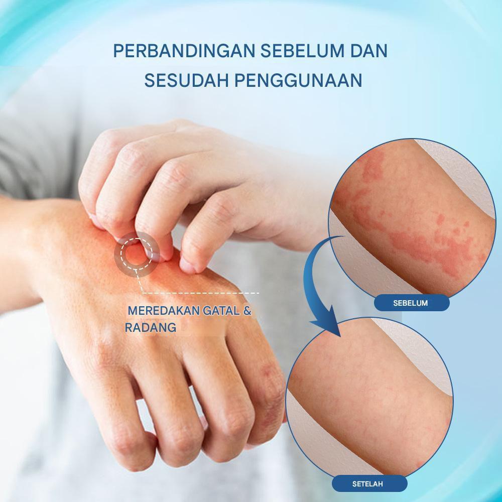 Sumifun Allergy Care Cream - Menghilangkan Kulit Gatal dan Alergi dengan Formula Lembut dan Efektif