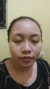 Product Review of DOSIS 2 ACNE - Paket Acne Ectoin+ Extra [for your Acne Treatment] from c**🦀 2