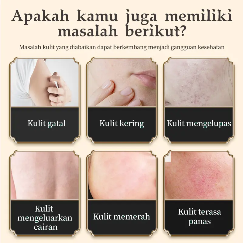 Kreain Krim Perbaikan Eksim Memperbaiki kulit eksim yang gatal, kemerahan, dan bercak putih Meredakan gatal-gatal Menghilangkan rasa gatal Melembapkan dan menutrisi kulit 1
