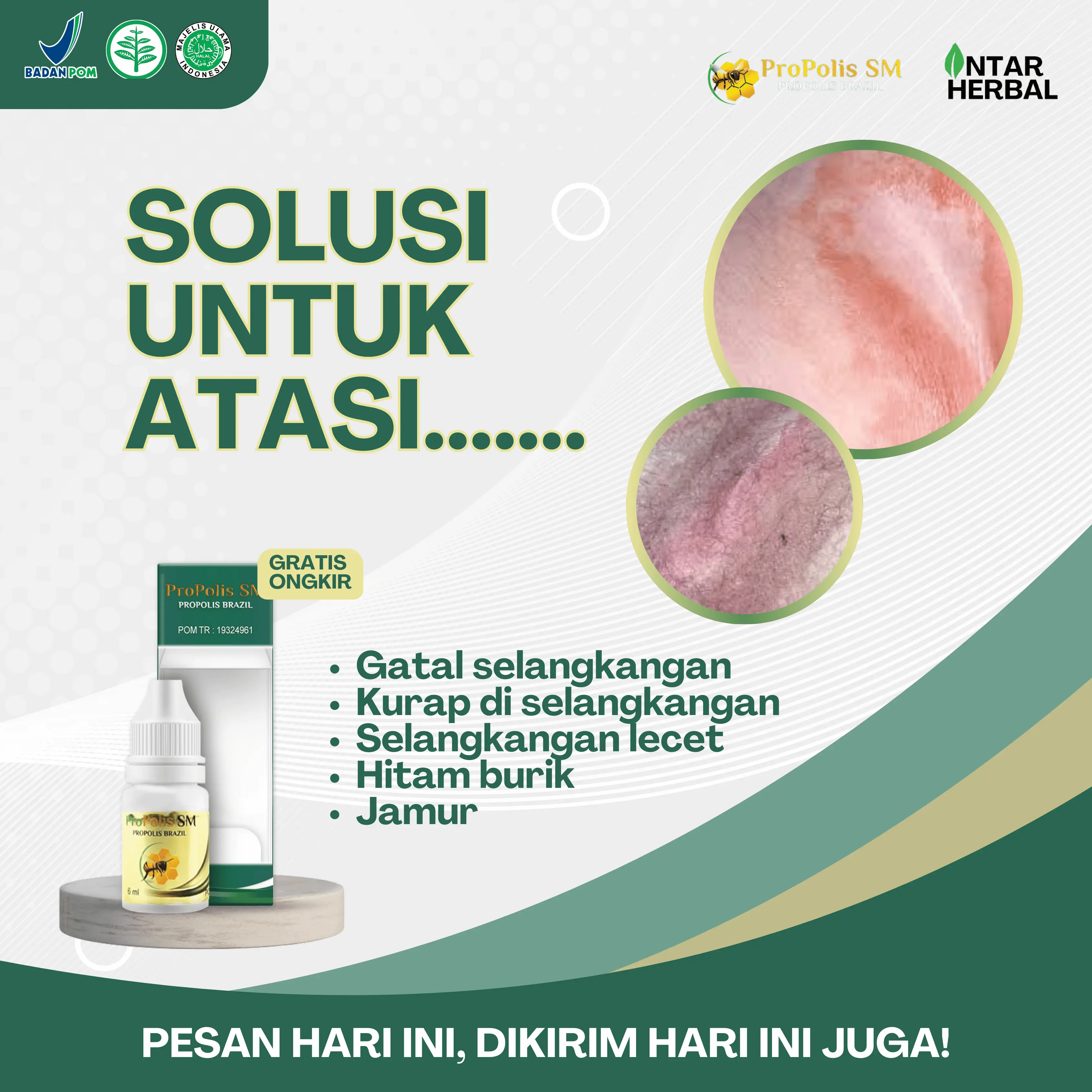 Salep Gatal Selangkangan, Selangkangan Lecet, Pemutih Selangkangan Hitam, Selangkangan Jamuran, Penghilang Kurap Di Selangkangan Untuk Pria Dan Wanita Dengan Propolis SM
