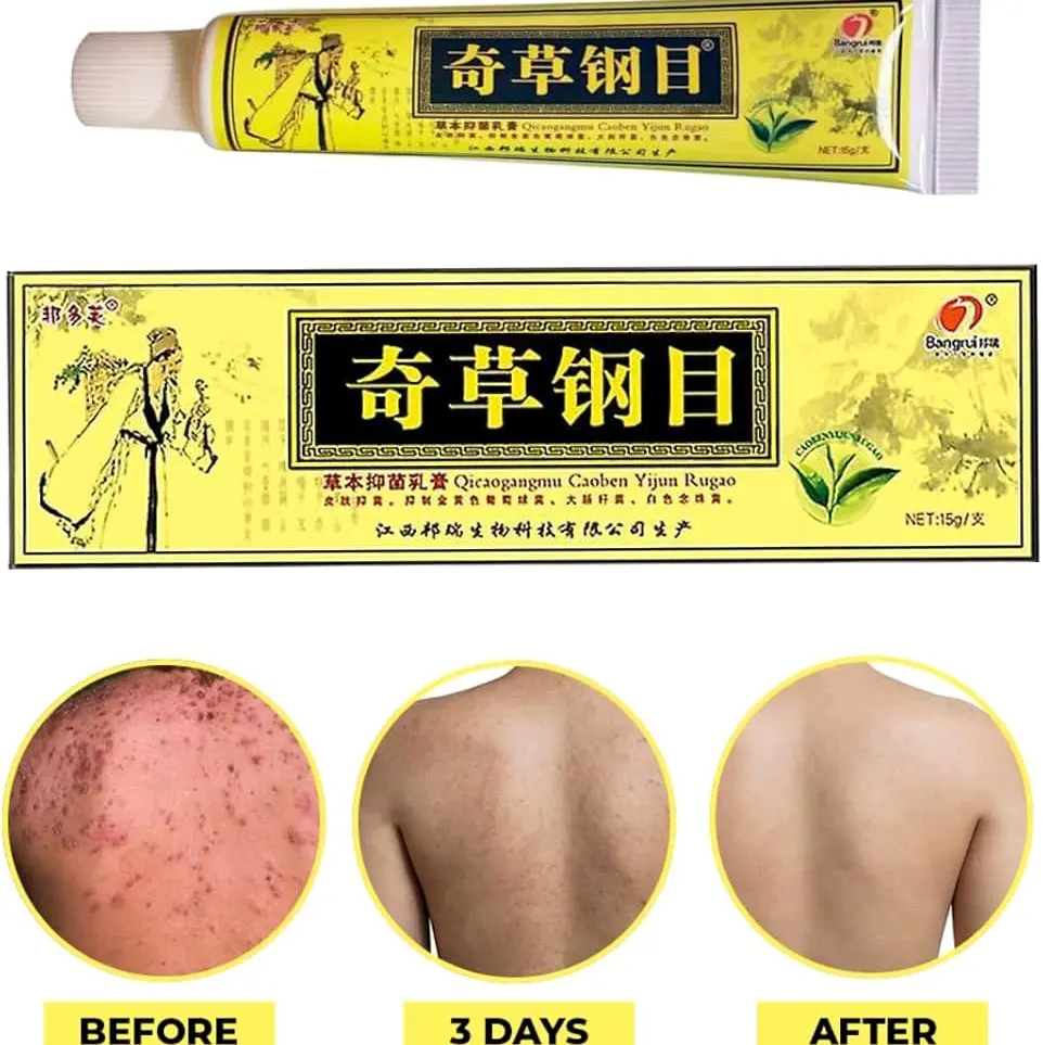$1.11/PC  HERB PSORIASIS 15g 10PC DEAL  PSORIASIS ECZEMA SKIN CREAM  ACNE SKIN MOISTURIZER