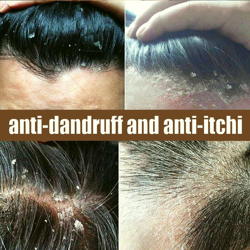 Shampo anti ketombe Penghilang ketombe berkerak dan gatal psoriasis kulit kepala Oil control Kulit kepala gatal Shampoo rambut 4