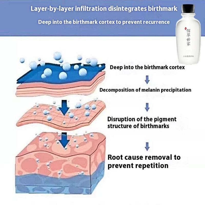 Product Introduction of Birthmark Remover Solution 100g Birthmark Removal liquid for Black, red, brown birthmarks on face Quick Remove Birthmark Penyingkiran Tanda Lahir 1