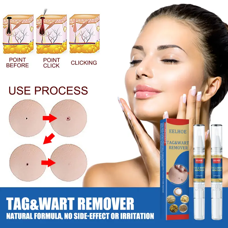 Wart Removal Pen Krim Penghilang Lalat, Krim Penghilang Kutil, Mudah Dibawa Untuk Semua Kulit, Krim Penghilang Kutil 6