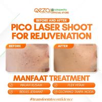 Gambar COMBO DNA SALMON KOREA + PICO LASER REJUVE + FACIAL Kerutan Perawatan Wajah Membersihkan dari qeza.clinic Kab. Sleman 3 Tokopedia