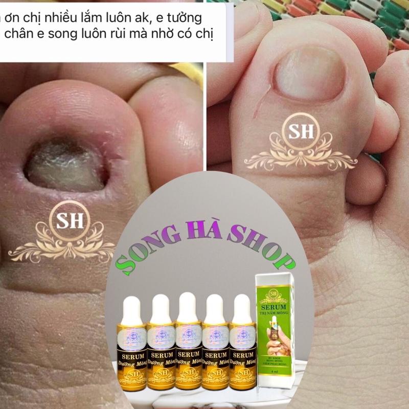 {CHÍNH HÃNG SH} 05 chai serum trị nấm móng, bọng móng, hư khoé, móng bị hư thối dưỡng  móng