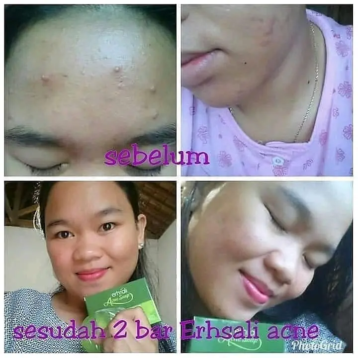 Sabun Wajah Erhsali Acne Soap Eaafs Original Nasa perawatan jerawat 5