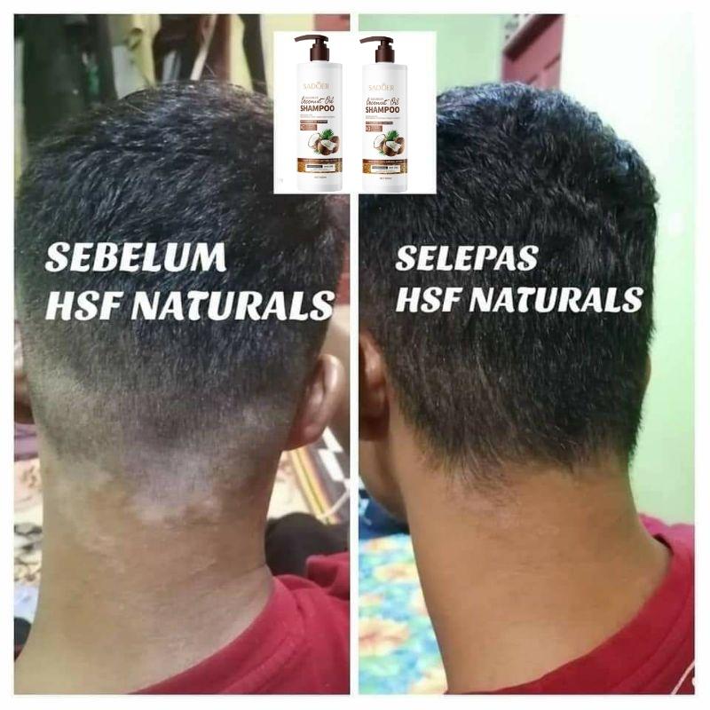 Shampo anti ketombe Penghilang ketombe berkerak dan gatal psoriasis kulit kepala Oil control Kulit kepala gatal Shampoo rambut 3