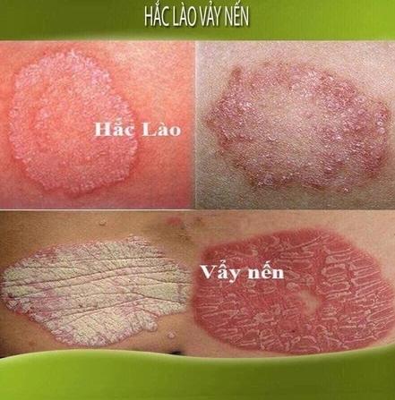 [Bọ Cạp Đỏ] Kem Bôi Ngoài Da Tri Nấm Ngứa Ông Già Nội Địa Trung 6