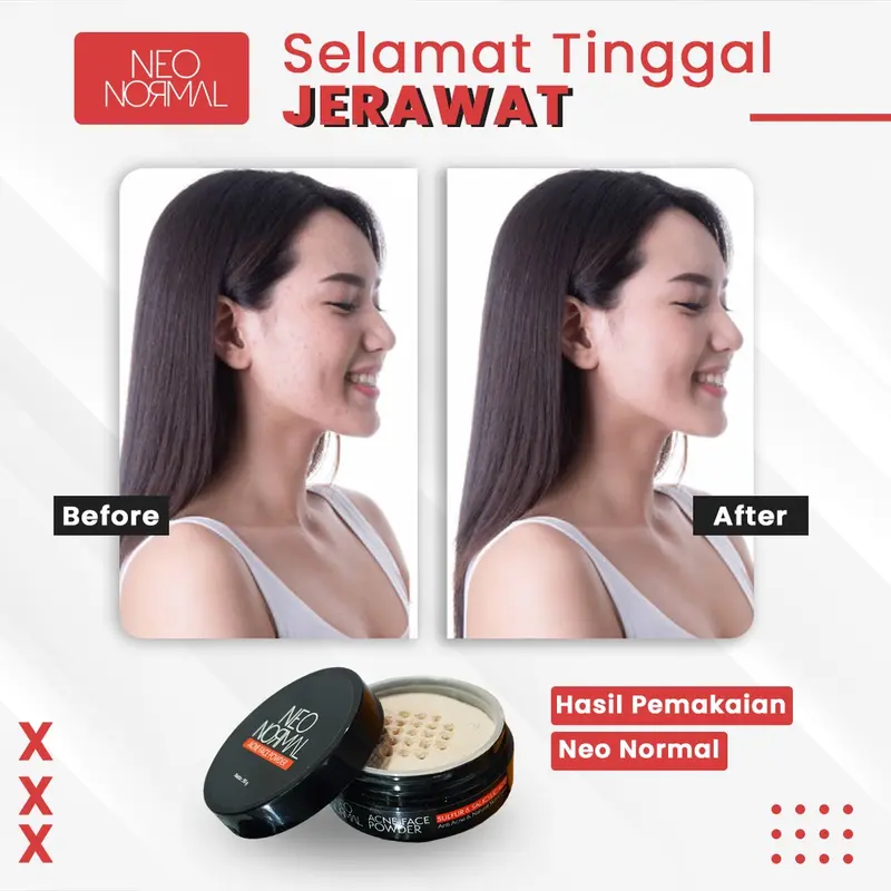 NEO NORMAL Acne Face Powder (Penghilang Jerawat / Anti Acne) 4