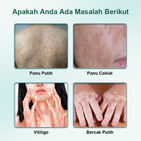 salep khusus bercak putih vitiligo salep vitiligo, bercak-bercak putih vitiligo cream bercakputih penyakit kulit putih/panu putih/kudis putih/lepra putih