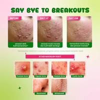 Gambar 【HEMAT】LUMIWHITE - Paket Acne Shield Series (FREE 1 SACHET RANDOM+CLOUD PADS) dari LUMIWHITE Kota Administrasi Jakarta Pusat 3 Tokopedia