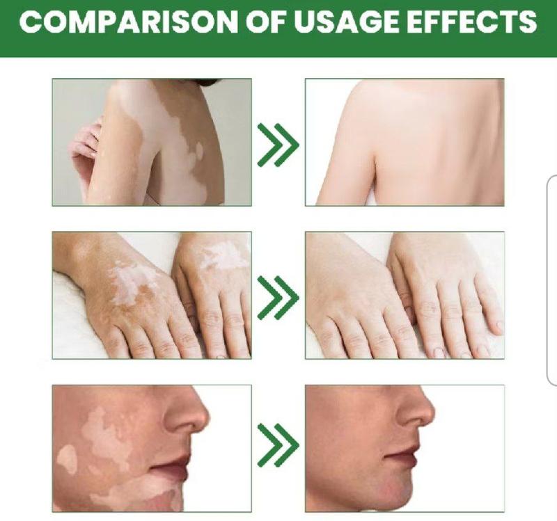 krim penghilang vitiligo menghilanglan jamur panu dan mengatur pigmentasi kulit / vitiligo repair cream 3