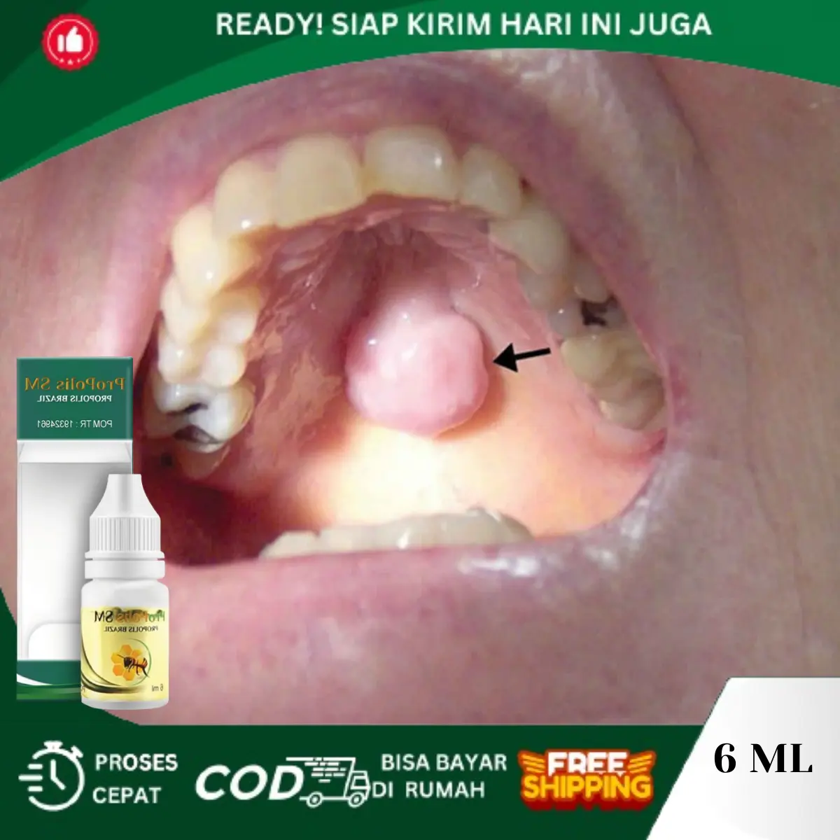 Benjolan Keras DiLangit Mulut, Penghilang Benjolan Dilangit Mulut, Benjolan DiKelenjar Air Liur, Penyakit Torus Palatinus, Tetes Penghancur Benjolan Di Langit Mulut, Kista DiKelenjar Air Liur