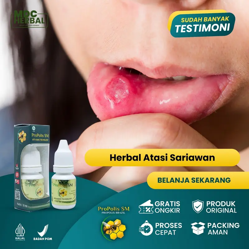 Herbal Sariawan Di Lidah Sariawan Di Mulut Benjolan Di Lidah Panas Dalam Lidah Pecah Pecah Jamur Di Lidah Bintik Bintik Putih Di Lidah - Propolis SM 0